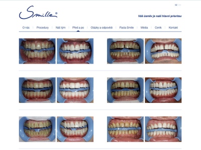 Smille - bělení zubů 